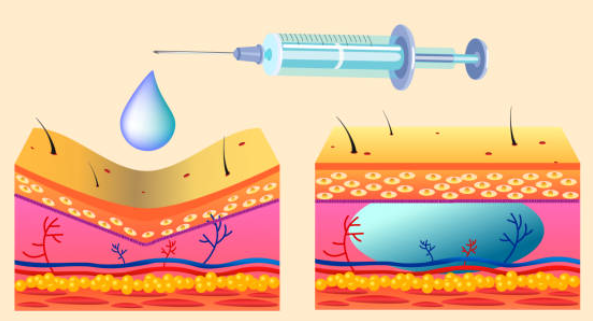 diagrama-injection-acido